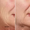 silk'n FaceTite FTC1PE1001 – sejas ādas savilkšanas un konturēšanas ierīce
