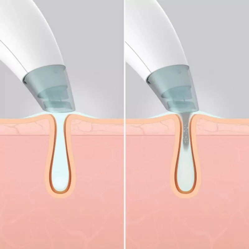HoMedics FAC-HY100 hidradermabrāzijas tīrīšanas ierīce, caurspīdīga, balta